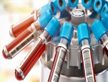 Trombose em pequenos vasos é característica de covid-19, diz estudo